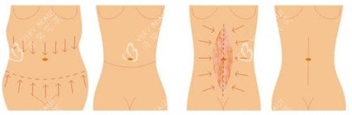 不同程度的腰腹