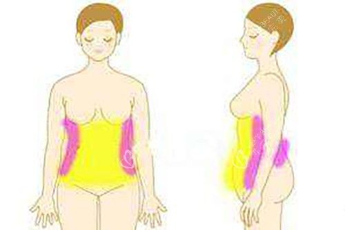 腰腹吸脂卡通示意图