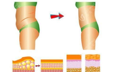 腰腹吸脂对比图