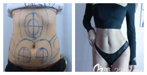 昆明韩辰李宁腰腹部吸脂案例效果对比图