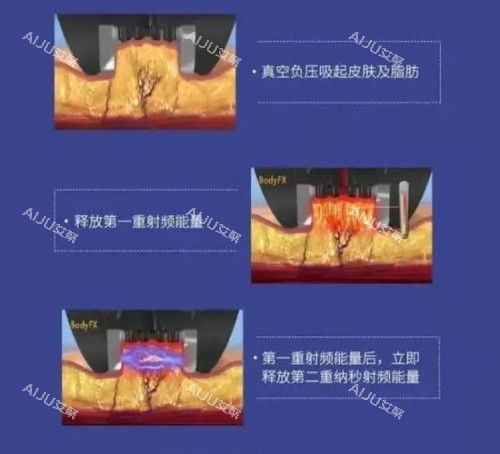 钻石超塑整形的优势示意图