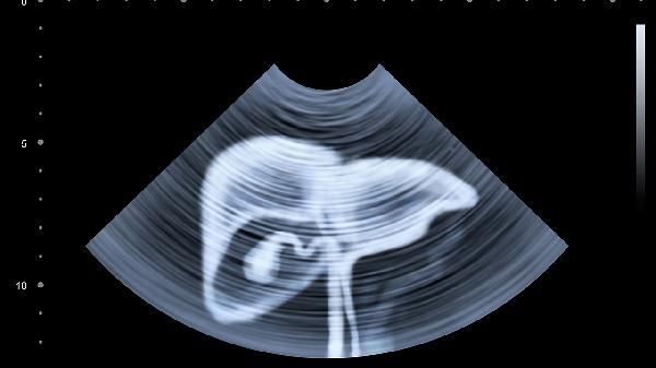 腹部吸脂手术的价格