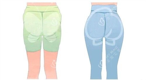 臀部吸脂手术背面对比动画图