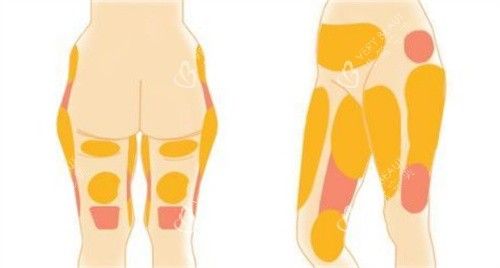 腿部吸脂部位