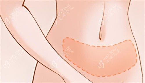 吸脂腹部区域