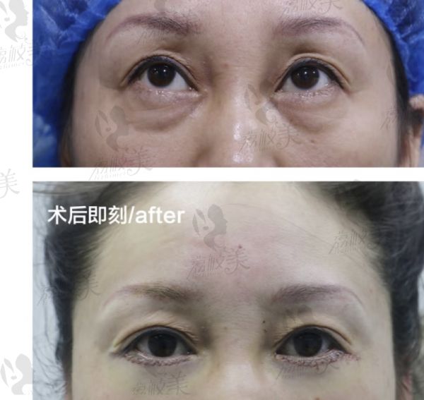 腰腹吸脂手术：成效与风险怎样权衡？