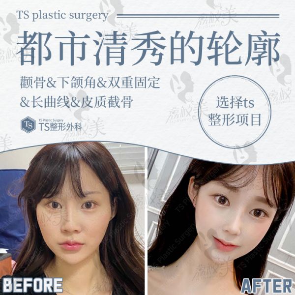 不同部位吸脂价格情况如何？