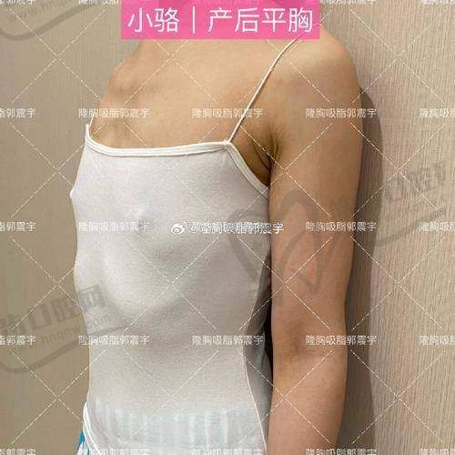 吴国勇脂肪种植胸技术是怎么做到70%-85%高存活率的？