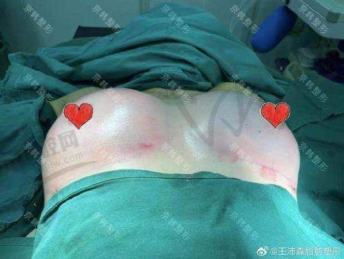 脂肪种植胸技术适合所有人群吗？哪些人不建议做？