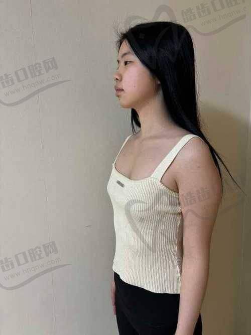 价格区间透明吗？吴国勇脂肪种植胸手术价格表来了