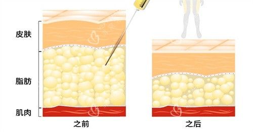吸脂手术前后