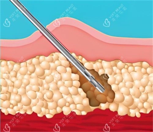 吸脂手术皮肤层