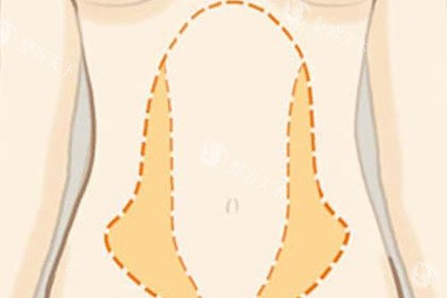 腰腹吸脂位置示意图