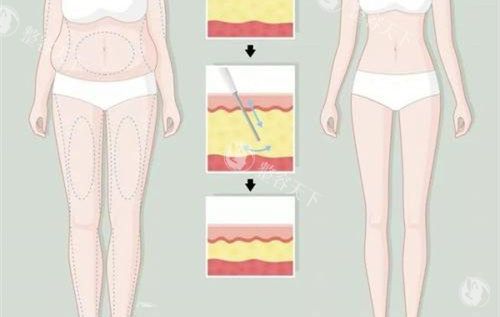 大腿环吸前后对比卡通示意图