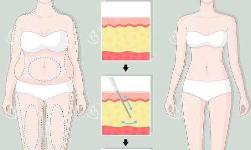 全身吸脂展示图