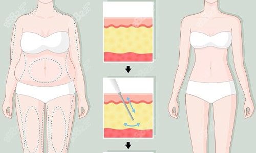 全身吸脂展示图
