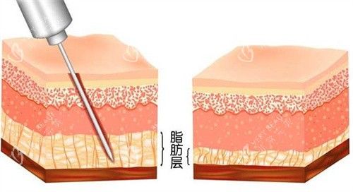 吸脂手术怎么做的