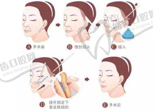 李增辉医生擅长哪些吸脂部位及成效怎样?