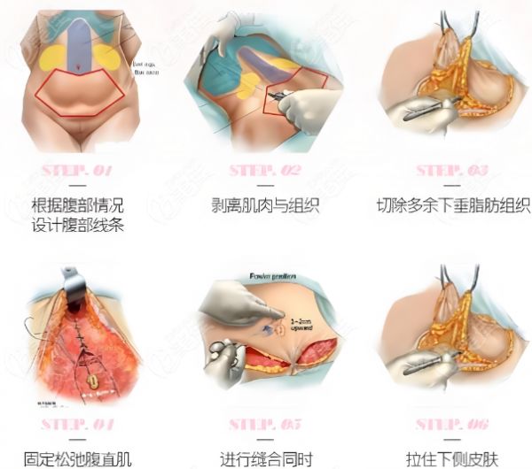 刘宾医生做腹壁手术好
