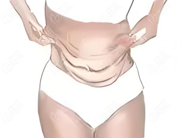 刘宾医生腹壁成功实例