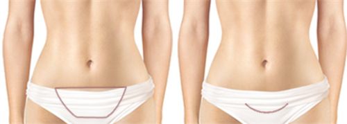 迷你腹壁整形手术展示图