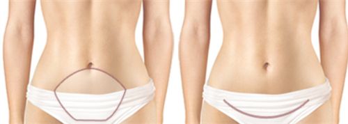 全腹壁整形手术