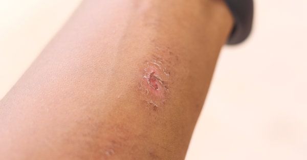 阴囊皮疼什么原因