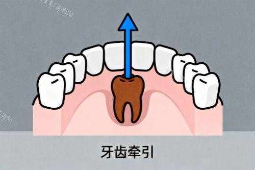 牙齿牵引卡通图