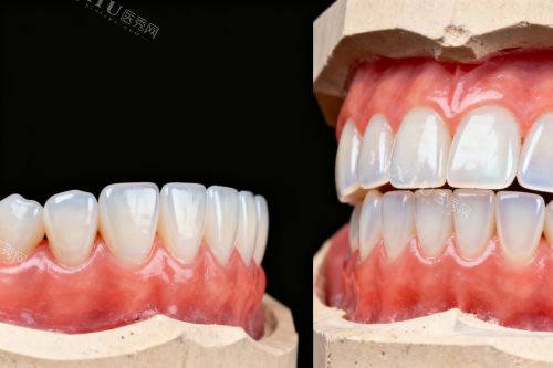 牙齿贴面前后对比图