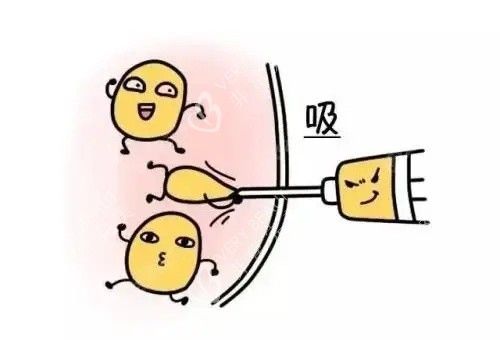 抽脂漫畫示意圖