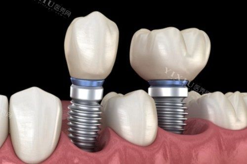 種植牙修復(fù)卡通一覽