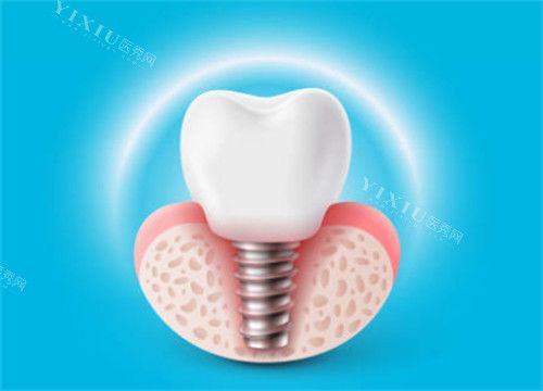 種植牙有光圈示意圖