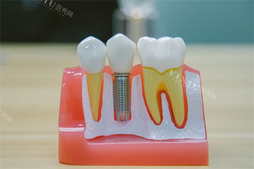 牙科種植牙模型