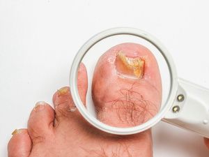 白醋泡蒜治灰指甲配方