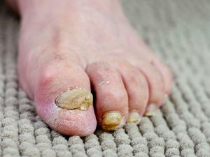 白醋治灰指甲的配方