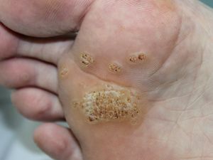 白醋治療雞眼的配方