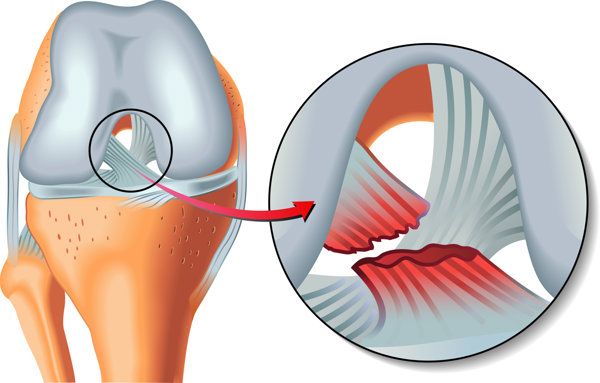 前叉瘢痕松懈怎么治疗