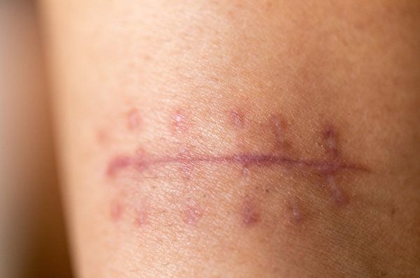 前叉瘢痕松懈怎么治疗