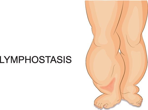 食管癌晚期身上會癢嗎