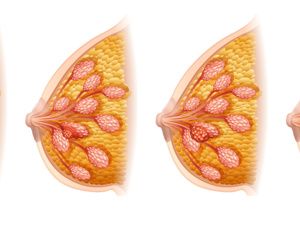 怎么避免喂奶乳腺炎复发