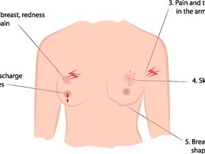 坐月子乳头皲裂乳腺炎