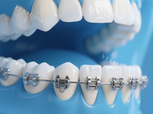 牙齿矫正示意图