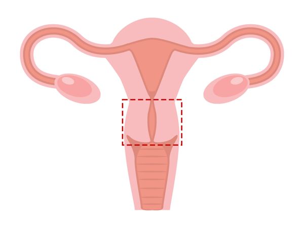 宫颈分离会是宫颈癌吗