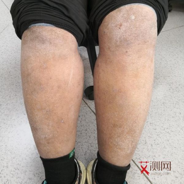 艾滋病的常见症状a+b+c