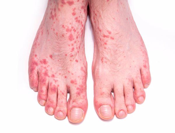 梅毒早期会检测到吗