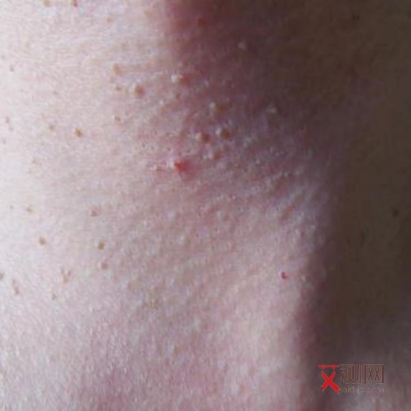 艾滋病前期表现是什么样