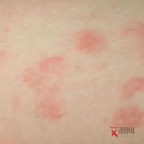 艾滋病前期表现是什么样