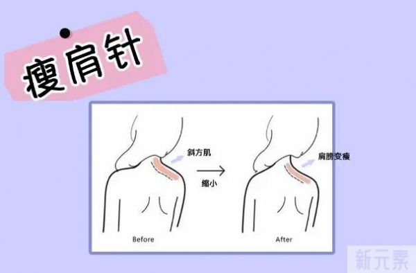 这款既能瘦脸、瘦腿，又能控油、除皱的轻医美真的绝! 图片-3
