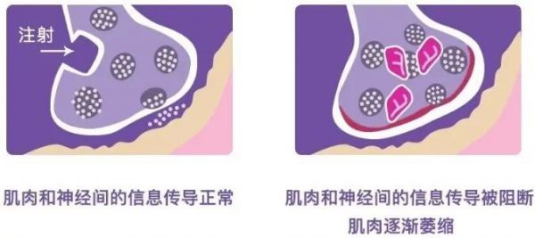 这款既能瘦脸、瘦腿，又能控油、除皱的轻医美真的绝! 图片-6