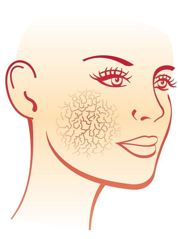 脸部痒出油怎么回事